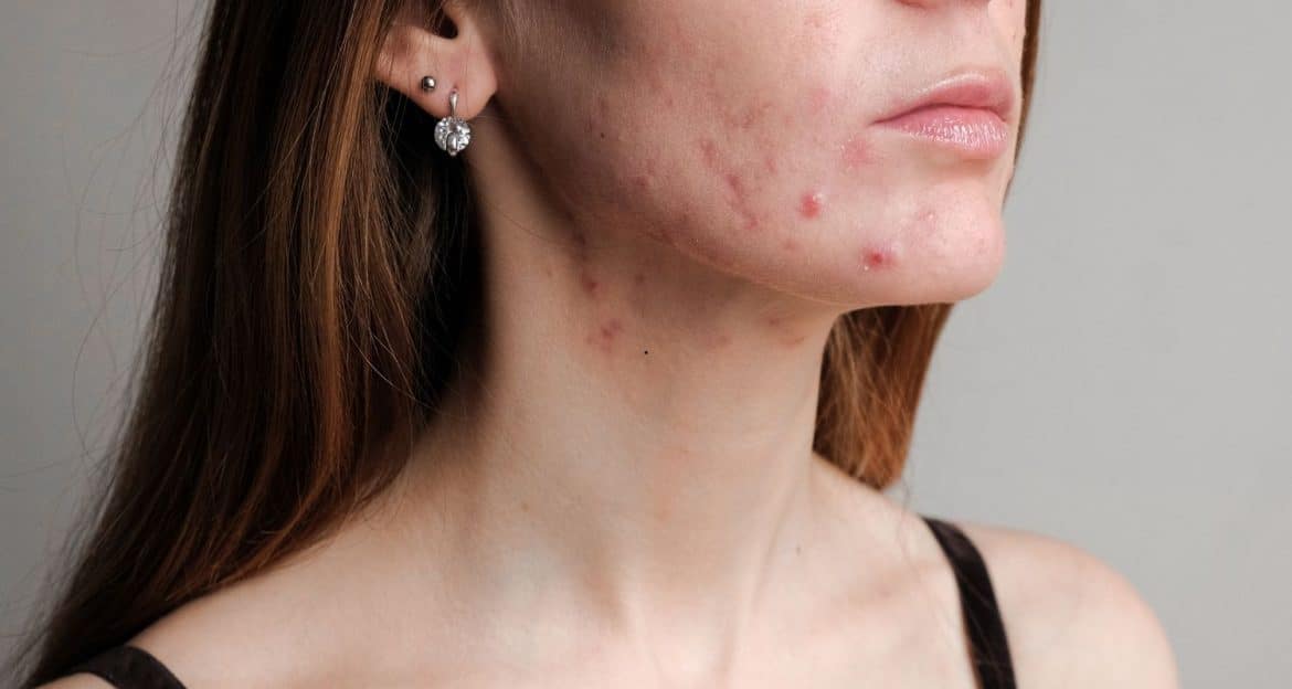 Acneea, dincolo de coșuri: ce spune medicina modernă despre inflamație, hormoni și piele