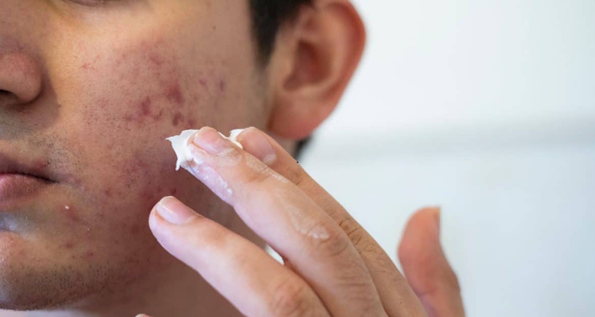 Acneea hormonală: ce se întâmplă de fapt în piele