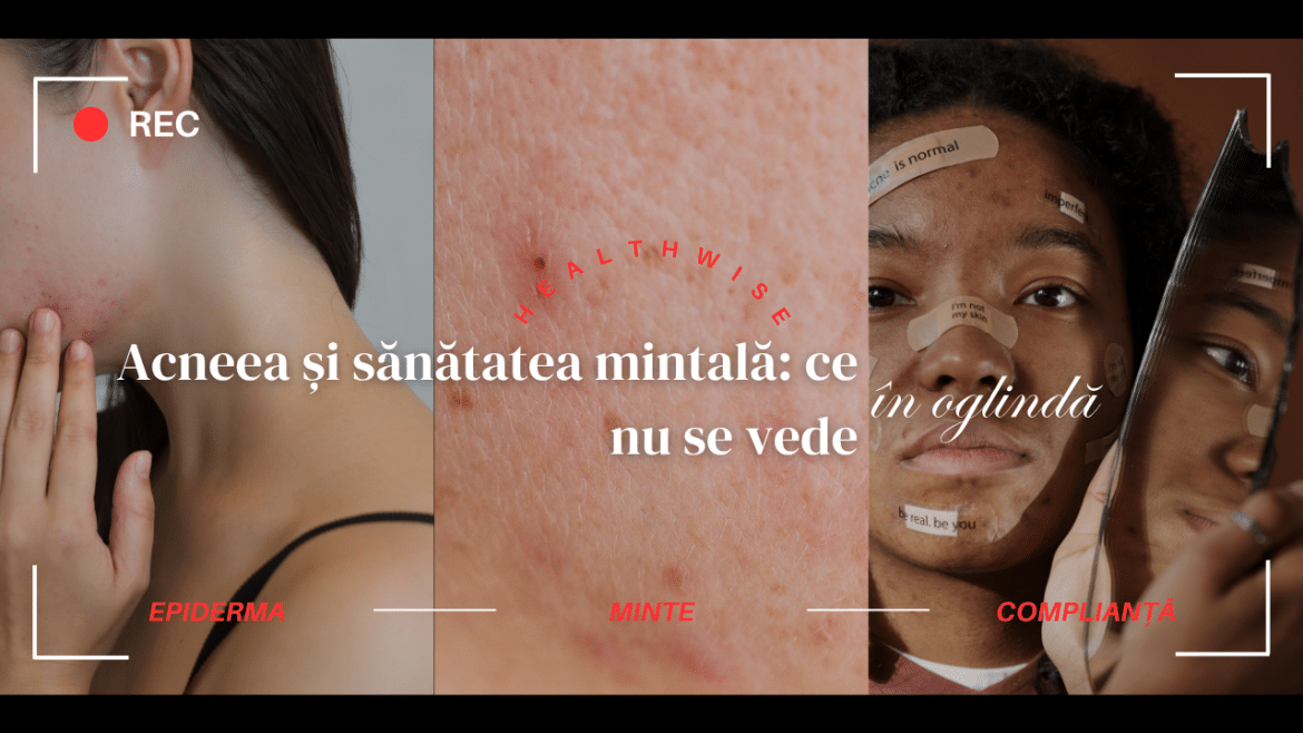 Acneea și sănătatea mintală: ce nu se vede în oglindă