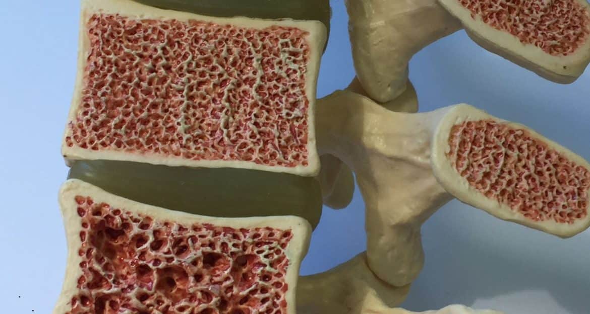Osteoporoza — factori de risc, prevenție și ce nutrienți contează cu adevărat