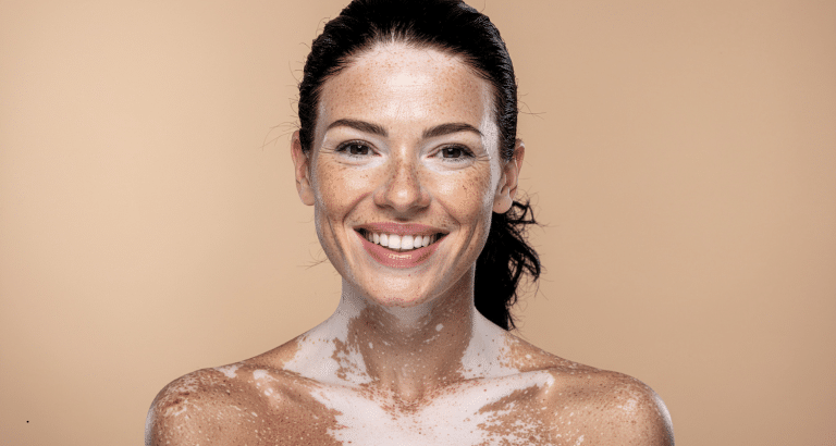 Vitiligo nu este doar o pată albă pe piele &mdash; este pierderea locală a melanocitelor și a toleranței imune