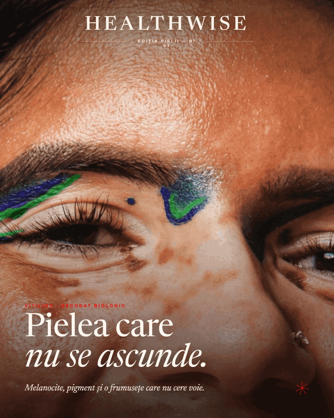 Vitiligo — carusel editorial Healthwise