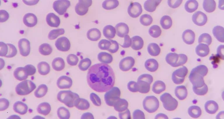 ANC neutrofile: de ce procentul poate ascunde o neutropenie