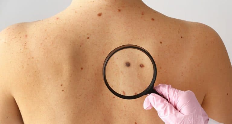 Melanomul malign nu incepe la plaja &ndash; incepe cand pielea acumuleaza leziuni UV pe care nu le mai poate repara