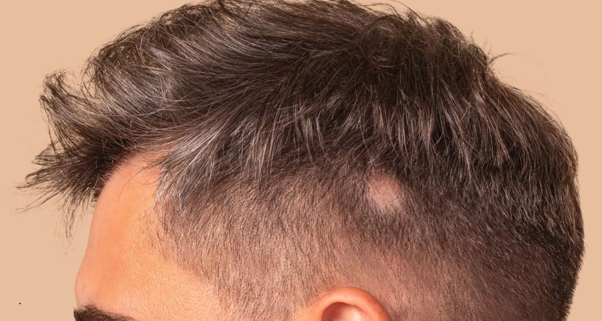 Alopecia areata: când sistemul imun oprește temporar ciclul normal al firului de păr