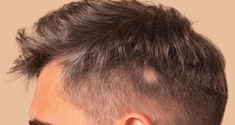 Alopecia areata: c&acirc;nd sistemul imun oprește temporar ciclul normal al firului de păr