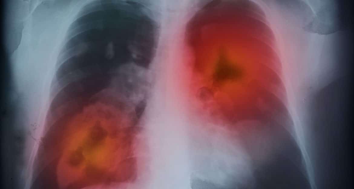 De ce vârsta singură nu explică prognosticul în cancerul pulmonar la vârstnici