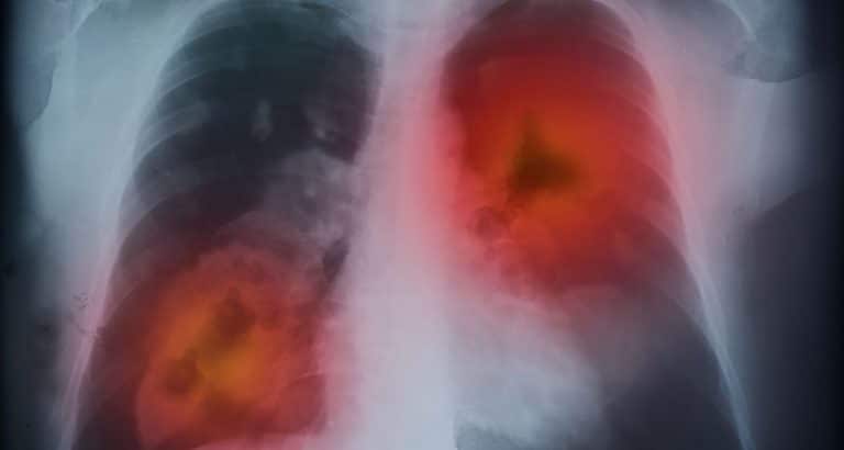 De ce v&acirc;rsta singură nu explică prognosticul &icirc;n cancerul pulmonar la v&acirc;rstnici