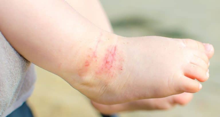 Dermatita atopică la copii: simptome, cauze și tratament conform ghidurilor AAD 2026