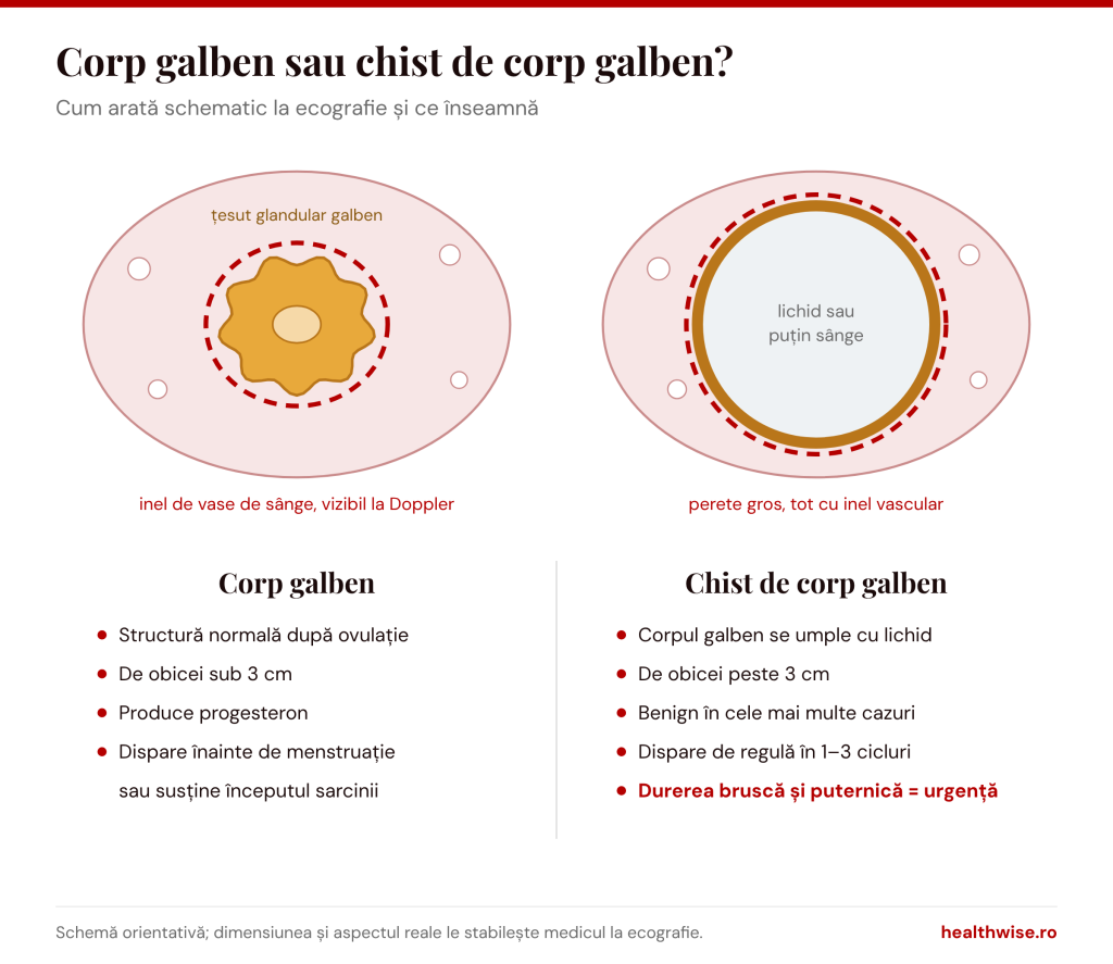 Diferența dintre corpul galben și chistul de corp galben, schemă orientativă